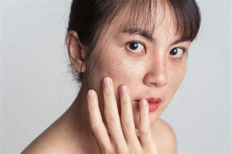 臉頰黑斑|黑斑 (Melasma)